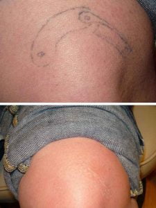 Fading Fast - Laser Tattoo Removal and Fading Specialist